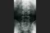 Axial Psoriatic Arthritis and Ankylosing Spondylitis: Comparing Clinical, Radiologic Characteristics Axial Psoriatic Arthritis and Ankylosing Spondylitis: Comparing Clinical, Radiologic Characteristics