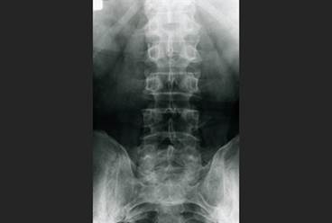 Axial Psoriatic Arthritis and Ankylosing Spondylitis: Comparing Clinical, Radiologic Characteristics Axial Psoriatic Arthritis and Ankylosing Spondylitis: Comparing Clinical, Radiologic Characteristics