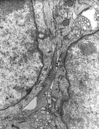 The first confirmed human case of Keystone virus has been diagnosed in a Florida teen. <i> Photo Credit: CDC/ Dr Fred Murphy; Sylvia Whitfield </i> The first confirmed human case of Keystone virus has been diagnosed in a Florida teen. <i> Photo Credit: CDC/ Dr Fred Murphy; Sylvia Whitfield </i>