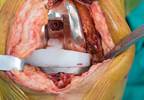 Expert Q&A: A Clinical Update on the Prevention, Treatment of Periprosthetic Joint Infections Expert Q&A: A Clinical Update on the Prevention, Treatment of Periprosthetic Joint Infections