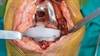 Expert Q&A: A Clinical Update on the Prevention, Treatment of Periprosthetic Joint Infections Expert Q&A: A Clinical Update on the Prevention, Treatment of Periprosthetic Joint Infections