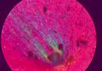 Monosodium Urate Crystal Deposits Common in Asymptomatic Sons of Individuals With Gout Monosodium Urate Crystal Deposits Common in Asymptomatic Sons of Individuals With Gout