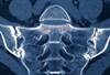 Gender Differences in Axial Spondyloarthritis: Comparing Disease Burden and Treatment Gender Differences in Axial Spondyloarthritis: Comparing Disease Burden and Treatment