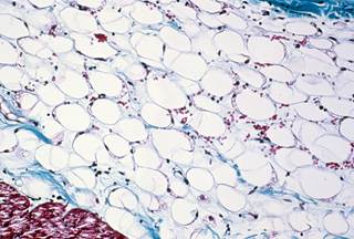Cachexia is often overlooked in patients with rheumatoid arthritis because of its unique presentation in this patient population. <i>Credit: Biophoto Associates/Science Source</i> Cachexia is often overlooked in patients with rheumatoid arthritis because of its unique presentation in this patient population. <i>Credit: Biophoto Associates/Science Source</i>