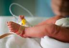 Preterm Birth, Low Birth Weight Associated With Hip Osteoarthritis Preterm Birth, Low Birth Weight Associated With Hip Osteoarthritis