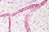 Low Nailfold Capillary Density Associated With Lung Involvement in Juvenile Dermatomyositis Low Nailfold Capillary Density Associated With Lung Involvement in Juvenile Dermatomyositis