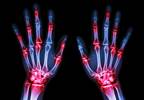 Novel JAK Inhibitor Peficitinib Effective, Tolerable in Treating Rheumatoid Arthritis Novel JAK Inhibitor Peficitinib Effective, Tolerable in Treating Rheumatoid Arthritis