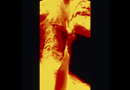 Swallowing Disorders in RA: Epidemiology and Patient Management Swallowing Disorders in RA: Epidemiology and Patient Management