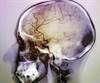 Examining the Spectrum of Neurologic Manifestations in Antiphospholipid Syndrome Examining the Spectrum of Neurologic Manifestations in Antiphospholipid Syndrome