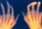 Positive Phase 3 Results With Filgotinib for Treatment-Resistant Rheumatoid Arthritis Positive Phase 3 Results With Filgotinib for Treatment-Resistant Rheumatoid Arthritis