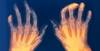 Positive Phase 3 Results With Filgotinib for Treatment-Resistant Rheumatoid Arthritis Positive Phase 3 Results With Filgotinib for Treatment-Resistant Rheumatoid Arthritis