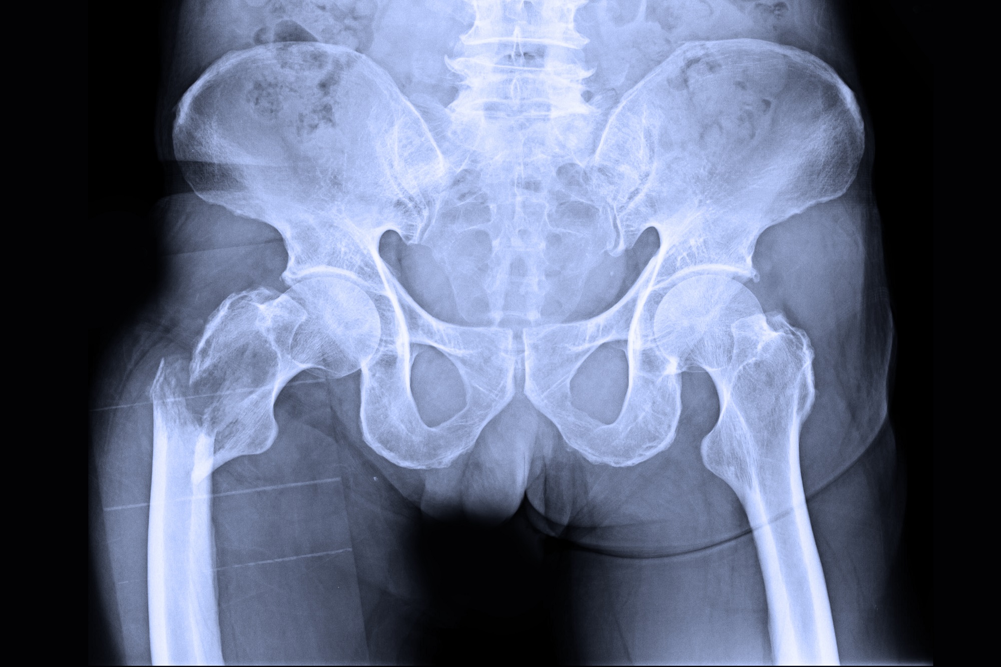 normal xray of hip