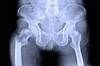 Decreased Osteoporosis Treatment Initiation Observed After Hip Fracture Decreased Osteoporosis Treatment Initiation Observed After Hip Fracture