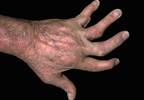 Minimal Disease Activity Provides Valid Assessment of Adalimumab-Treated Psoriatic Arthritis Minimal Disease Activity Provides Valid Assessment of Adalimumab-Treated Psoriatic Arthritis