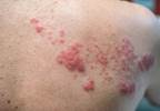 High Risk for Zoster in Cyclophosphamide-Treated SLE, Systemic Vasculitis High Risk for Zoster in Cyclophosphamide-Treated SLE, Systemic Vasculitis