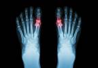 Patients With Early-Onset Gout Develop Earlier Metabolic Comorbidities, Severe Joint Involvement Patients With Early-Onset Gout Develop Earlier Metabolic Comorbidities, Severe Joint Involvement