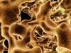 Real-World Data Show Reduced Fracture Rates in Teriparatide-Treated Osteoporosis Real-World Data Show Reduced Fracture Rates in Teriparatide-Treated Osteoporosis