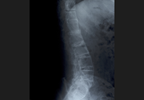 Assessment of Simultaneous Occurrence of Ankylosing Spondylitis and Diffuse Idiopathic Skeletal Hyperostosis Assessment of Simultaneous Occurrence of Ankylosing Spondylitis and Diffuse Idiopathic Skeletal Hyperostosis