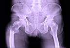 Sedation Level After Hip Fracture Repair May Not Affect Delirium Risk Sedation Level After Hip Fracture Repair May Not Affect Delirium Risk