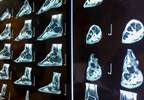 MRI-Detected Erosions in Undifferentiated Arthritis May Not Predict Risk for RA MRI-Detected Erosions in Undifferentiated Arthritis May Not Predict Risk for RA