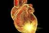 Subclinical Myocardial Inflammation Common in Rheumatoid Arthritis Subclinical Myocardial Inflammation Common in Rheumatoid Arthritis