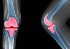 Exposure to Oral Osteoarthritis Therapies Not Linked to Increased Risk for Knee Replacement Exposure to Oral Osteoarthritis Therapies Not Linked to Increased Risk for Knee Replacement