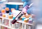 Prolonged Antimalarial Exposure Increases Risk for Elevated Cardiac Biomarkers in SLE Prolonged Antimalarial Exposure Increases Risk for Elevated Cardiac Biomarkers in SLE