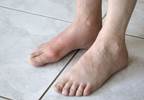 Factors Associated With Bone Erosion Identified in Gout Factors Associated With Bone Erosion Identified in Gout