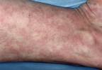 Active SLE Disease Activity, Damage Linked to Greater Mortality Active SLE Disease Activity, Damage Linked to Greater Mortality