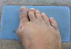 Long-Term Safety Data Raise No New Concerns for Approved Lesinurad Dose in Gout Long-Term Safety Data Raise No New Concerns for Approved Lesinurad Dose in Gout