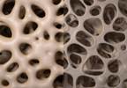 Low Muscle Strength, Bone Mineral Density Observed in Juvenile Idiopathic Arthritis Low Muscle Strength, Bone Mineral Density Observed in Juvenile Idiopathic Arthritis