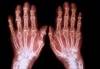 Undifferentiated Arthritis: Identifying Candidates for Early Treatment to Prevent Progression to RA Undifferentiated Arthritis: Identifying Candidates for Early Treatment to Prevent Progression to RA