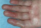 Clinical Gout-Related Benefits Not Demonstrated With Lesinurad Combination Therapy Clinical Gout-Related Benefits Not Demonstrated With Lesinurad Combination Therapy