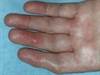 Clinical Gout-Related Benefits Not Demonstrated With Lesinurad Combination Therapy Clinical Gout-Related Benefits Not Demonstrated With Lesinurad Combination Therapy