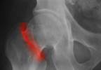 Risk for Subsequent Osteoporotic Fracture Elevated in Men vs Women Risk for Subsequent Osteoporotic Fracture Elevated in Men vs Women