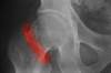 Risk for Subsequent Osteoporotic Fracture Elevated in Men vs Women Risk for Subsequent Osteoporotic Fracture Elevated in Men vs Women