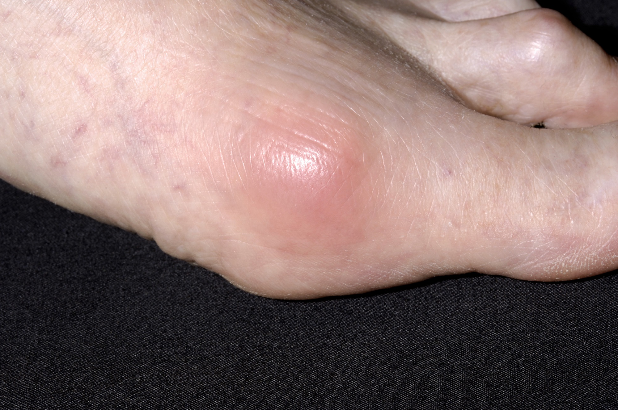 Routine Knee Metatarsophalangeal Joint Examination May Improve Gout Diagnosis