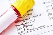 High C Reactive Protein MMP 9 Increase Poststroke Death And Disability