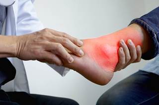 Longer-term studies are needed to support the cost effectiveness and safety of lesinurad in combination with XOI therapy in patients with gout. <i>Image Credit: ISM</i> Longer-term studies are needed to support the cost effectiveness and safety of lesinurad in combination with XOI therapy in patients with gout. <i>Image Credit: ISM</i>