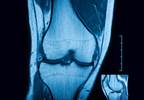Knee Effusion Volume Predicts Osteoarthritis Progression and Knee Replacement Knee Effusion Volume Predicts Osteoarthritis Progression and Knee Replacement