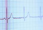Tocilizumab May Normalize QT Interval in Patients With Rheumatoid Arthritis Tocilizumab May Normalize QT Interval in Patients With Rheumatoid Arthritis