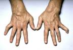 Upadacitinib Demonstrates Superiority vs Adalimumab, Placebo in Treatment-Resistant RA Upadacitinib Demonstrates Superiority vs Adalimumab, Placebo in Treatment-Resistant RA