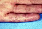 Novel Disease Activity Tool Validated to Detect Changes in SLE Novel Disease Activity Tool Validated to Detect Changes in SLE