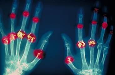 Bone Erosions More Frequent With Old Age at Onset of Early RA Bone Erosions More Frequent With Old Age at Onset of Early RA