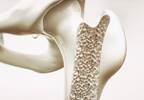 RAAS Inhibitors Do Not Increase Fracture Risk, Osteoporosis in Postmenopausal Women RAAS Inhibitors Do Not Increase Fracture Risk, Osteoporosis in Postmenopausal Women