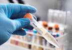 SERPINA3 Identified as Candidate Urinary Biomarker for Lupus Nephritis Activity SERPINA3 Identified as Candidate Urinary Biomarker for Lupus Nephritis Activity