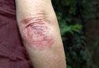 Gout Associated With Psoriatic Arthritis, Psoriasis in Adults Gout Associated With Psoriatic Arthritis, Psoriasis in Adults