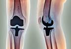 Prediction Models Developed to Predict Risk for Total Hip, Knee Replacements Prediction Models Developed to Predict Risk for Total Hip, Knee Replacements