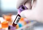 Cell-Bound Complement Activation Products May Help Pediatric-Onset SLE Diagnosis Cell-Bound Complement Activation Products May Help Pediatric-Onset SLE Diagnosis
