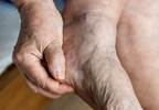 Urate-Lowering Therapy Reduces Non-Episodic Foot Pain in Patients Without Gout Diagnosis Urate-Lowering Therapy Reduces Non-Episodic Foot Pain in Patients Without Gout Diagnosis